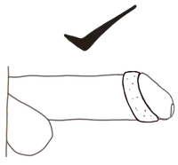 Correct Comfortring placement — behind the glans with curved edge facing outward
